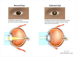 8 Tips for Preventing Cataracts